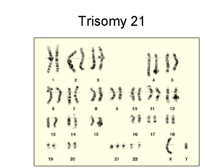 Trisomy 21 