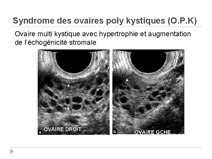 Syndrome des ovaires poly kystiques (O. P. K) Ovaire multi kystique avec hypertrophie et