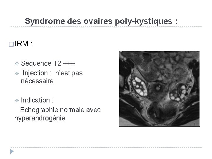 Syndrome des ovaires poly-kystiques : � IRM : Séquence T 2 +++ v Injection