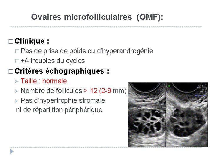 Ovaires microfolliculaires (OMF): � Clinique : � Pas de prise de poids ou d’hyperandrogénie