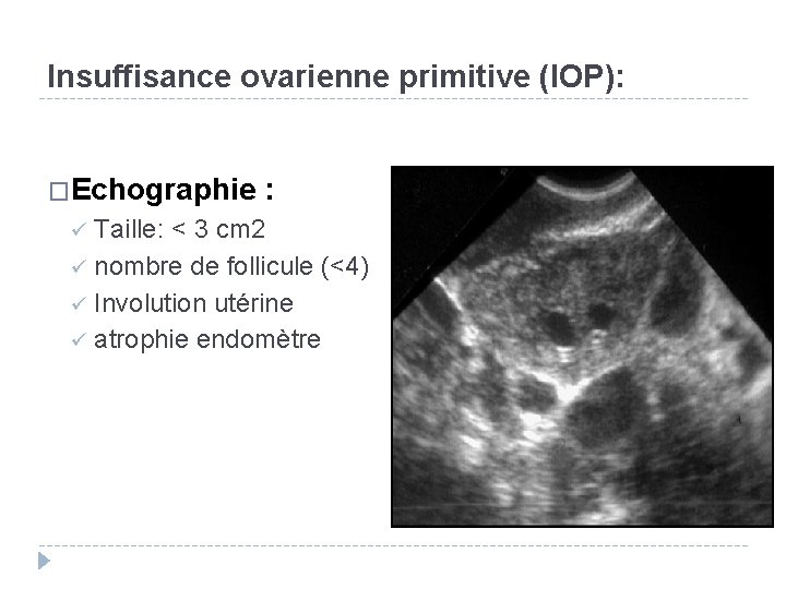 Insuffisance ovarienne primitive (IOP): �Echographie : Taille: < 3 cm 2 ü nombre de