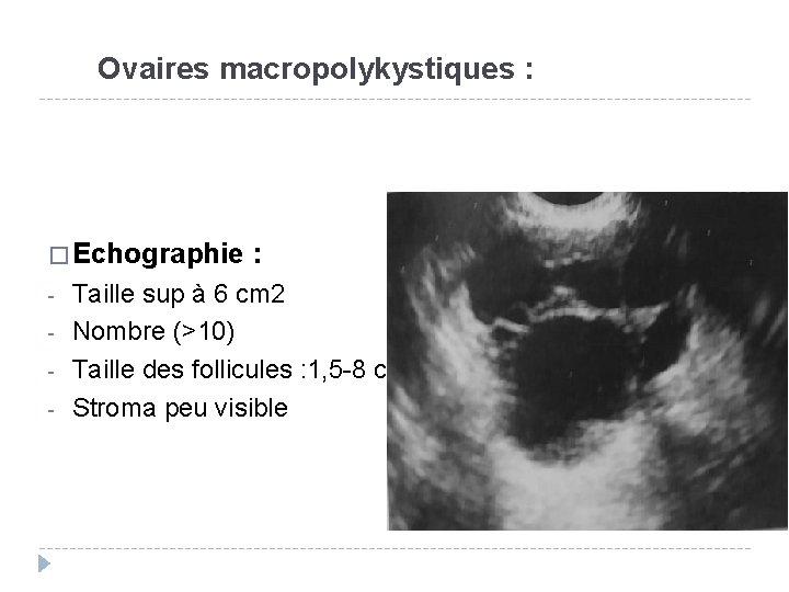 Ovaires macropolykystiques : � Echographie - : Taille sup à 6 cm 2 Nombre