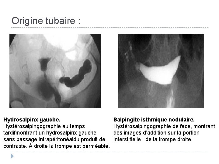 Origine tubaire : Hydrosalpinx gauche. Hystérosalpingographie au temps tardifmontrant un hydrosalpinx gauche sans passage