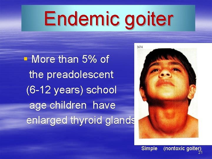 Endemic goiter § More than 5% of the preadolescent (6 -12 years) school age