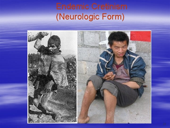 Endemic Cretinism (Neurologic Form) 23 