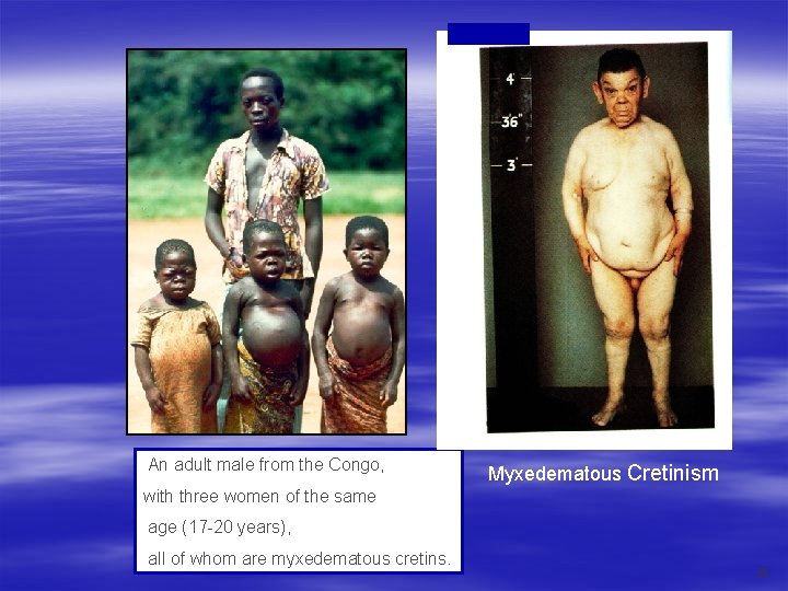An adult male from the Congo, Myxedematous Cretinism with three women of the same