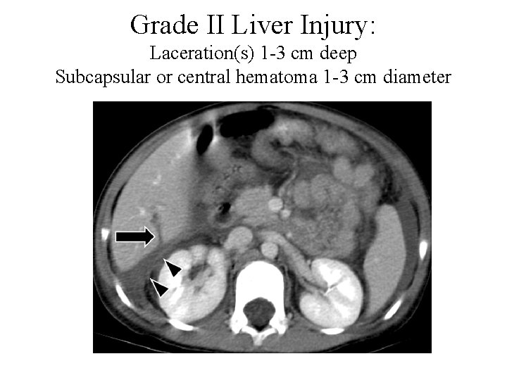 Grade II Liver Injury: Laceration(s) 1 -3 cm deep Subcapsular or central hematoma 1