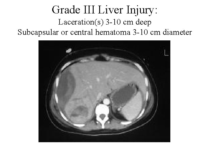 Grade III Liver Injury: Laceration(s) 3 -10 cm deep Subcapsular or central hematoma 3