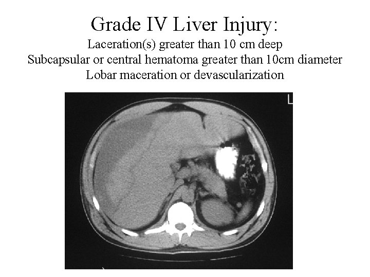 Grade IV Liver Injury: Laceration(s) greater than 10 cm deep Subcapsular or central hematoma