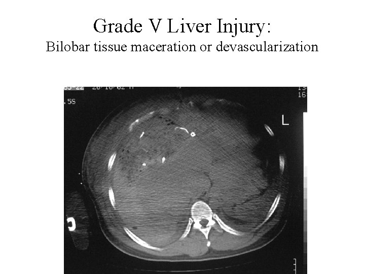 Grade V Liver Injury: Bilobar tissue maceration or devascularization 