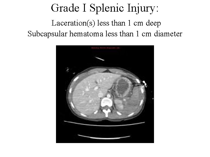 Grade I Splenic Injury: Laceration(s) less than 1 cm deep Subcapsular hematoma less than