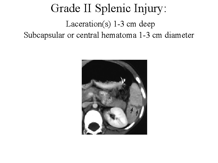 Grade II Splenic Injury: Laceration(s) 1 -3 cm deep Subcapsular or central hematoma 1