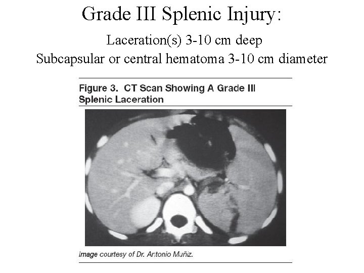 Grade III Splenic Injury: Laceration(s) 3 -10 cm deep Subcapsular or central hematoma 3