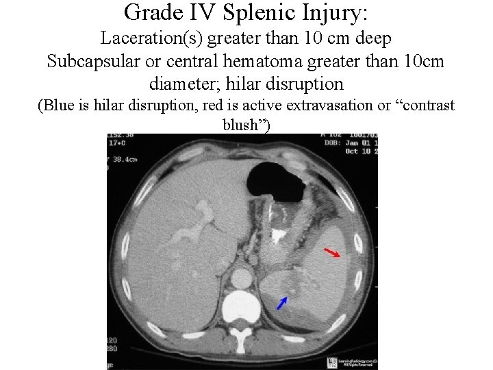 Grade IV Splenic Injury: Laceration(s) greater than 10 cm deep Subcapsular or central hematoma