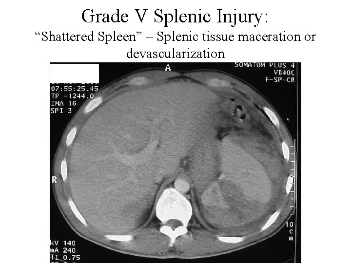 Grade V Splenic Injury: “Shattered Spleen” – Splenic tissue maceration or devascularization 