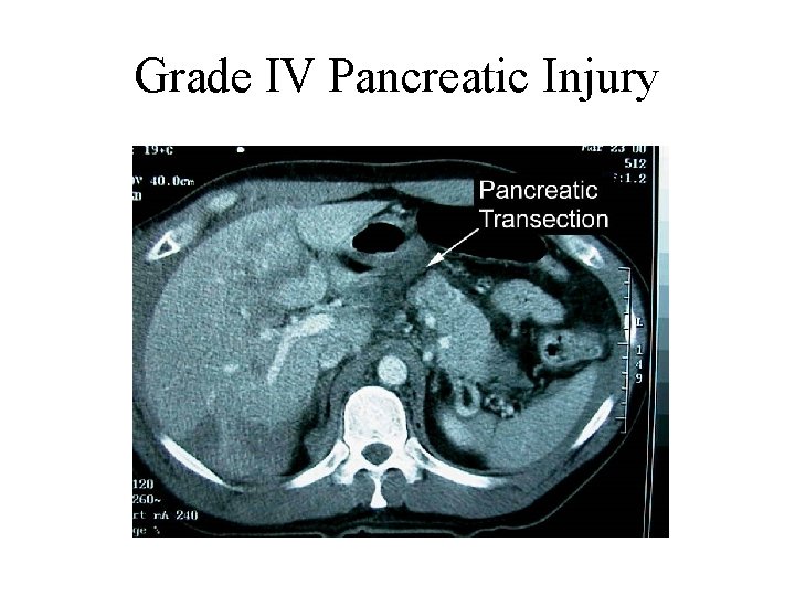 Grade IV Pancreatic Injury 