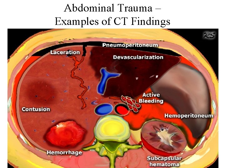 Abdominal Trauma – Examples of CT Findings 