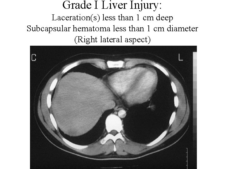 Grade I Liver Injury: Laceration(s) less than 1 cm deep Subcapsular hematoma less than