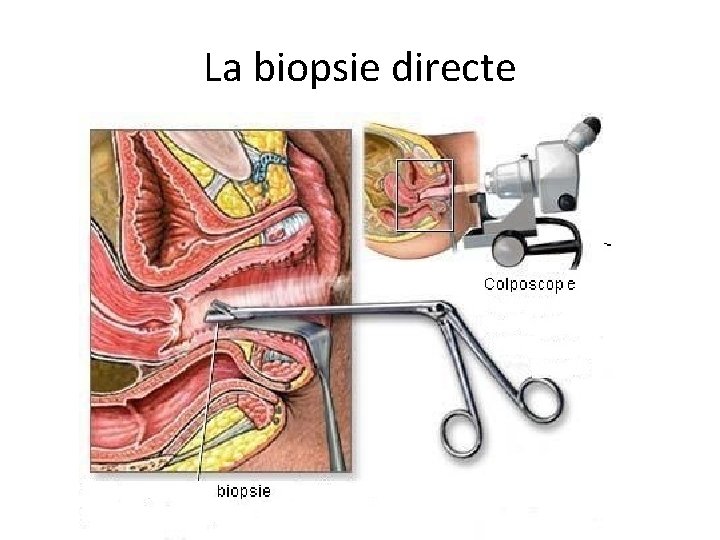 La biopsie directe 
