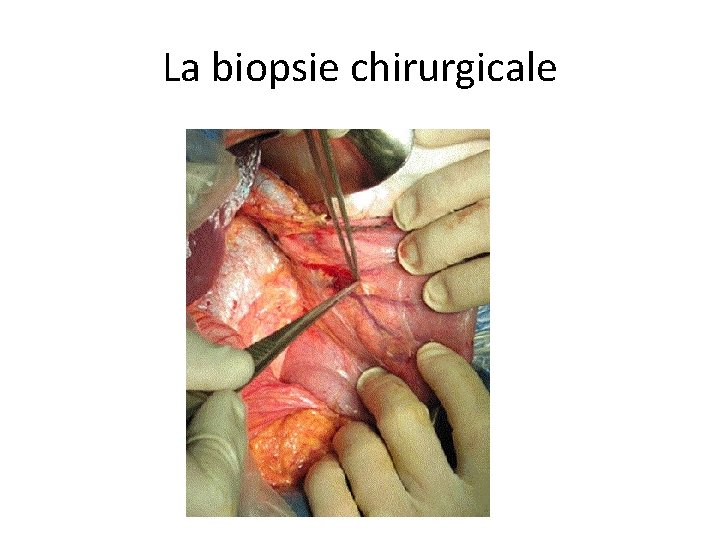La biopsie chirurgicale 