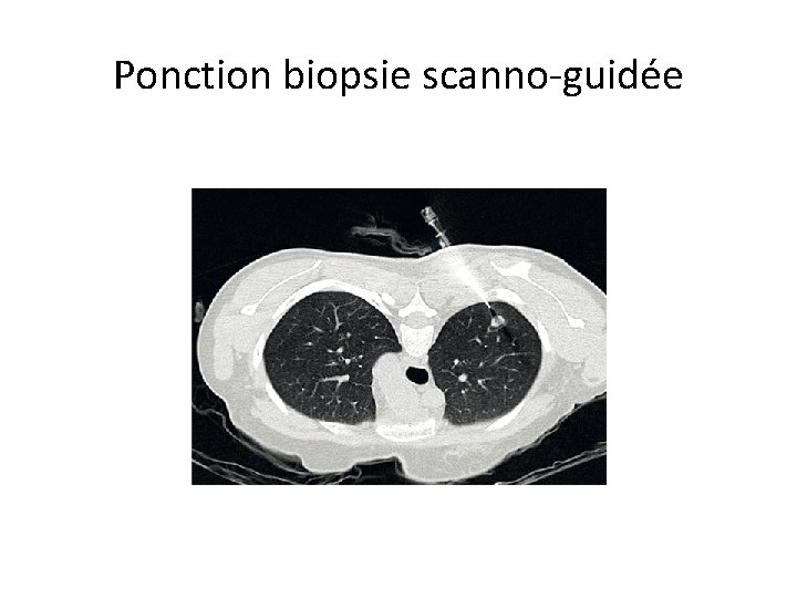 Ponction biopsie scanno-guidée 