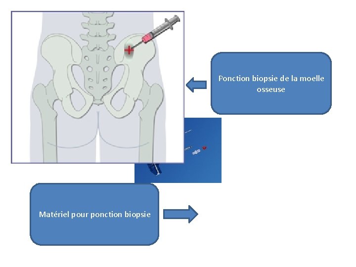 Ponction biopsie de la moelle osseuse Matériel pour ponction biopsie 