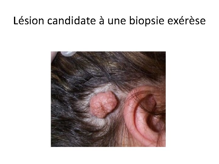 Lésion candidate à une biopsie exérèse 