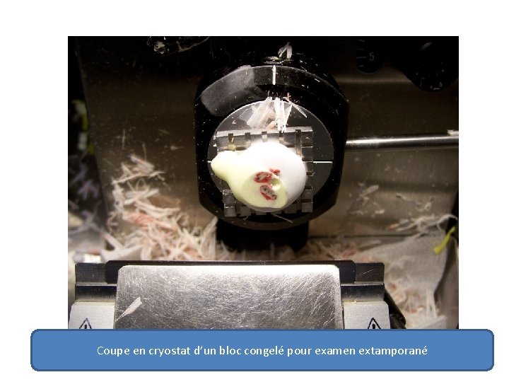 Coupe en cryostat d’un bloc congelé pour examen extamporané 