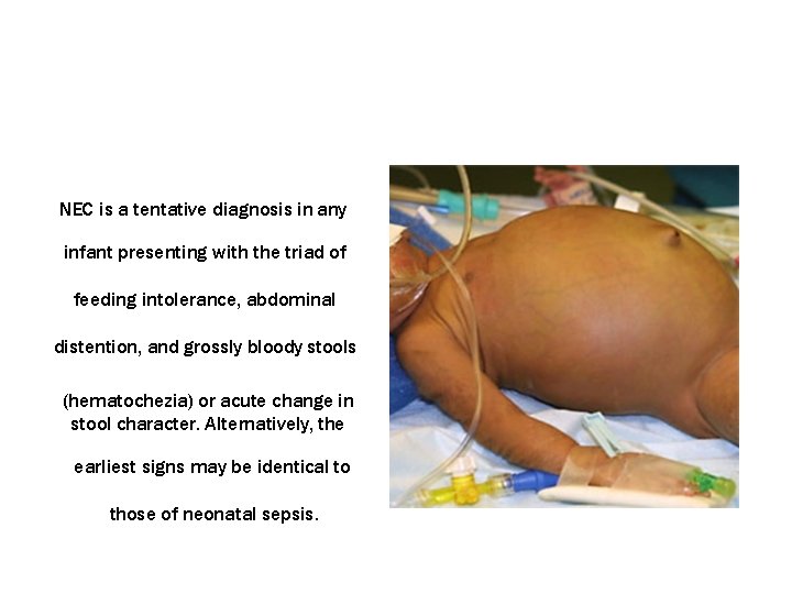 NEC is a tentative diagnosis in any infant presenting with the triad of feeding