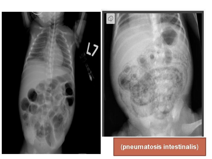 (pneumatosis intestinalis) 