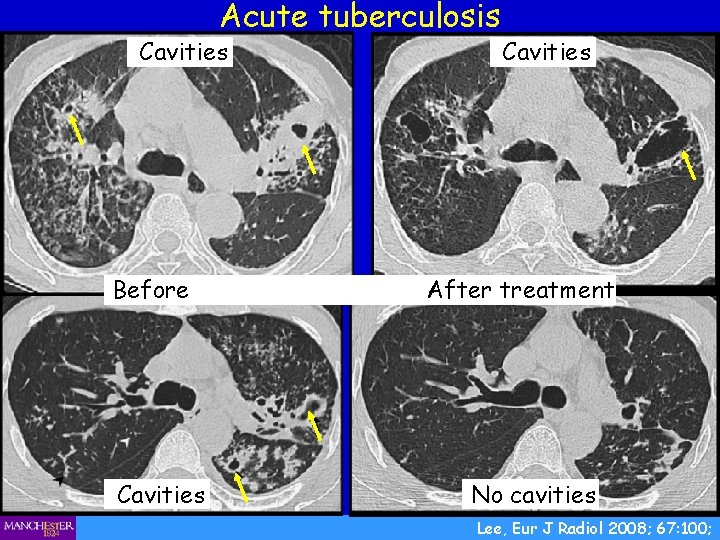Acute tuberculosis Cavities Before Cavities After treatment No cavities Lee, Eur J Radiol 2008;