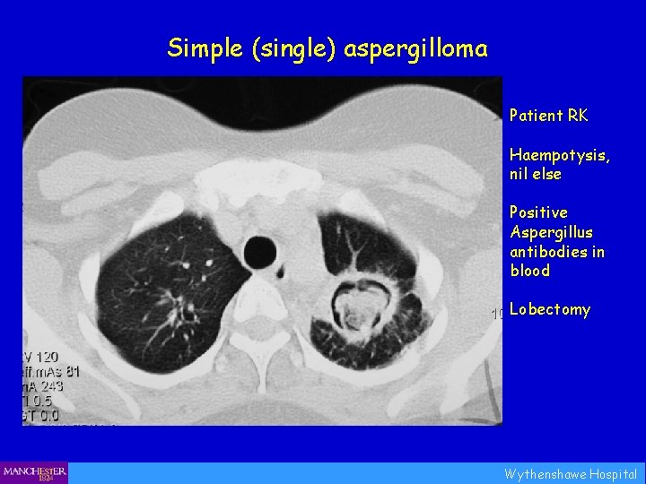 Simple (single) aspergilloma Patient RK Haempotysis, nil else Positive Aspergillus antibodies in blood Lobectomy