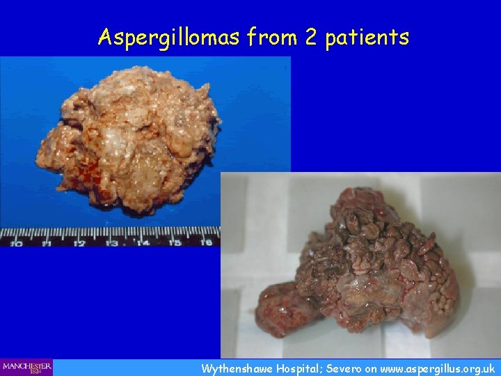 Aspergillomas from 2 patients Wythenshawe Hospital; Severo on www. aspergillus. org. uk 