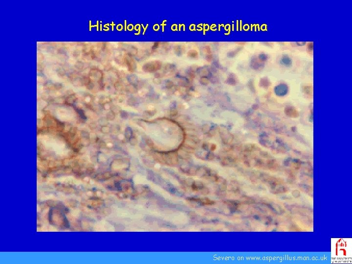 Histology of an aspergilloma Severo on www. aspergillus. man. ac. uk 