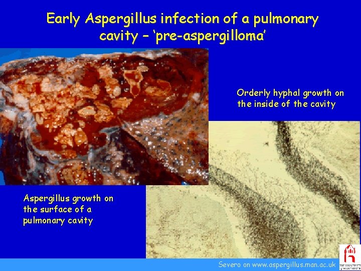 Early Aspergillus infection of a pulmonary cavity – ‘pre-aspergilloma’ Orderly hyphal growth on the