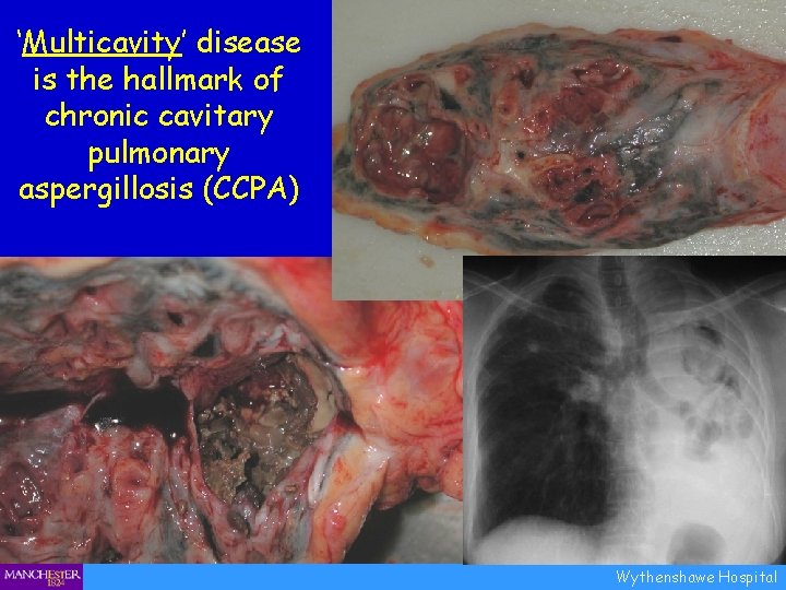 ‘Multicavity’ disease is the hallmark of chronic cavitary pulmonary aspergillosis (CCPA) Wythenshawe Hospital 