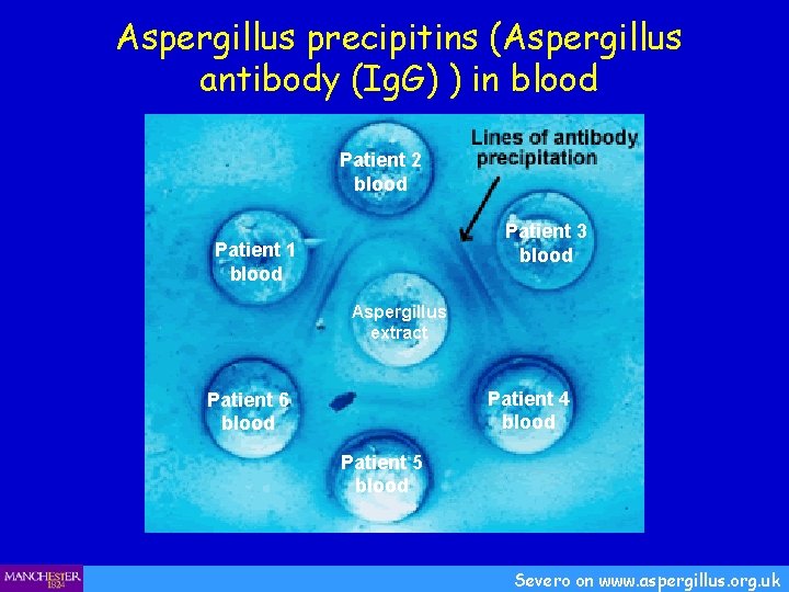 Aspergillus precipitins (Aspergillus antibody (Ig. G) ) in blood Patient 2 blood Patient 3