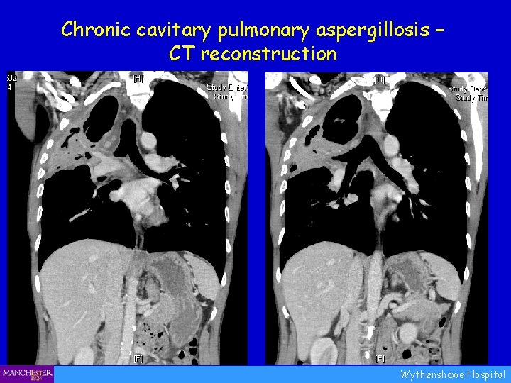 Chronic cavitary pulmonary aspergillosis – CT reconstruction Wythenshawe Hospital 