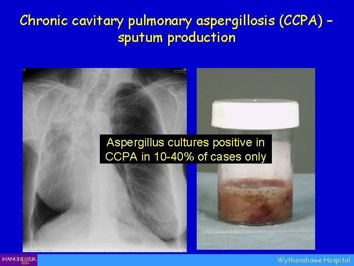 Chronic cavitary pulmonary aspergillosis (CCPA) – sputum production Aspergillus cultures positive in CCPA in