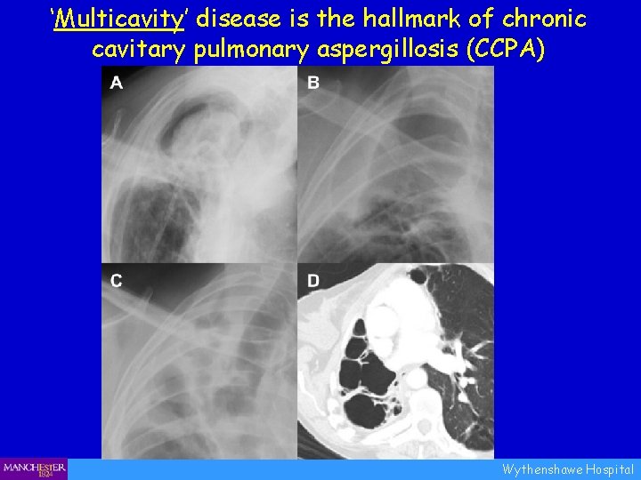 ‘Multicavity’ disease is the hallmark of chronic cavitary pulmonary aspergillosis (CCPA) Wythenshawe Hospital 