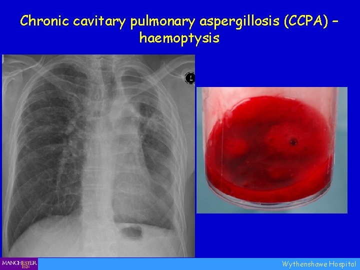 Chronic cavitary pulmonary aspergillosis (CCPA) – haemoptysis Wythenshawe Hospital 