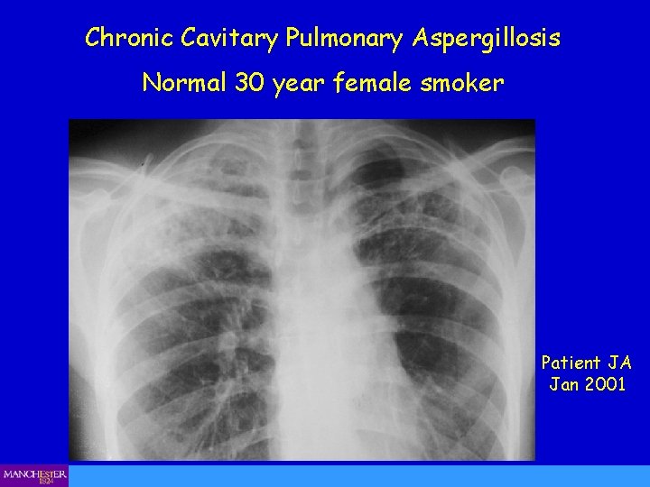 Chronic Cavitary Pulmonary Aspergillosis Normal 30 year female smoker Patient JA Jan 2001 