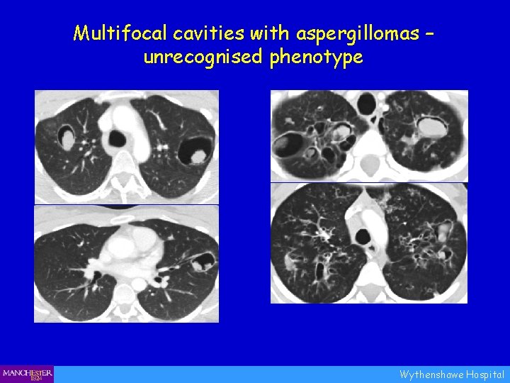 Multifocal cavities with aspergillomas – unrecognised phenotype Wythenshawe Hospital 