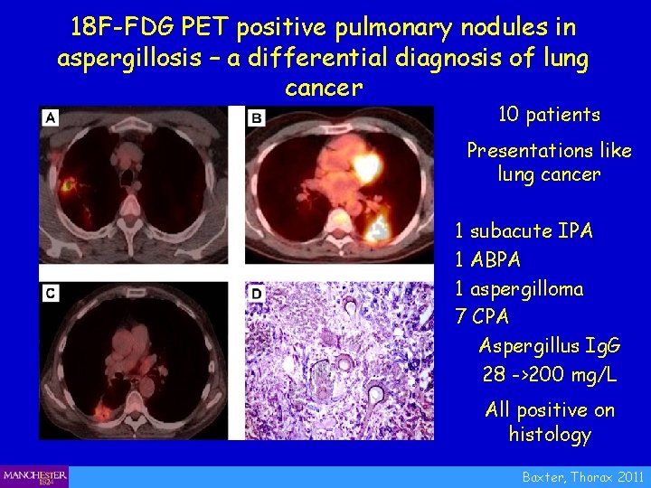 18 F-FDG PET positive pulmonary nodules in aspergillosis – a differential diagnosis of lung