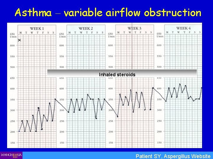 Asthma – variable airflow obstruction Inhaled steroids Patient SY, Aspergillus Website 