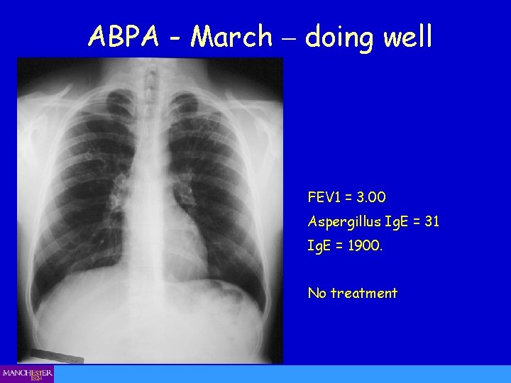 ABPA - March – doing well FEV 1 = 3. 00 Aspergillus Ig. E