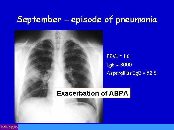 September – episode of pneumonia FEV 1 = 1. 6. Ig. E = 3000