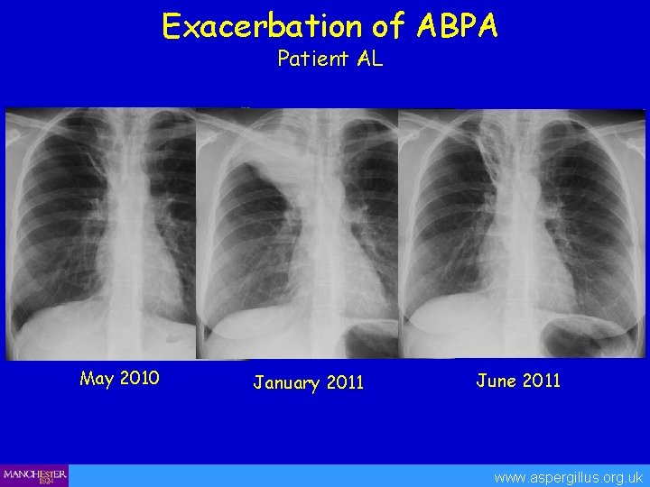 Exacerbation of ABPA Patient AL May 2010 January 2011 June 2011 www. aspergillus. org.