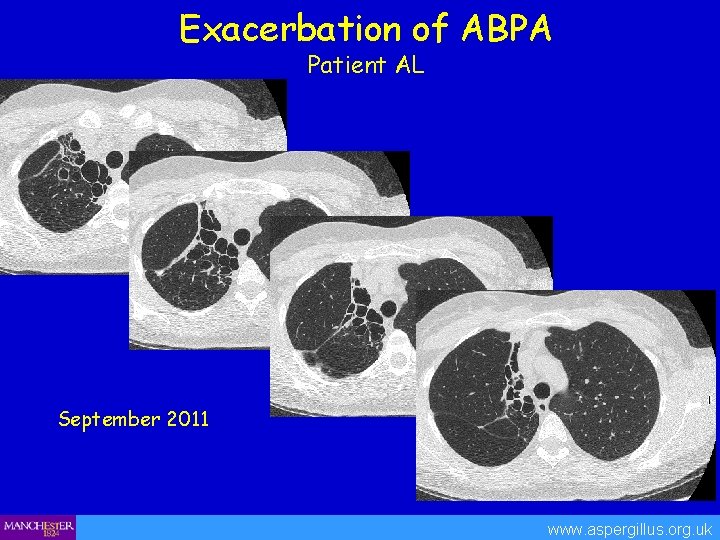 Exacerbation of ABPA Patient AL September 2011 www. aspergillus. org. uk 