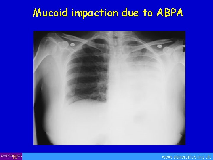 Mucoid impaction due to ABPA www. aspergillus. org. uk 